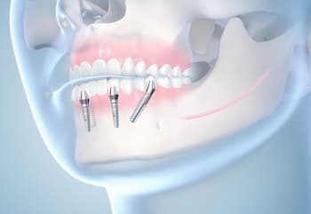 Современные методы имплантации зубов