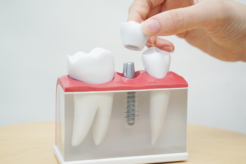 Имплантация зубов - противопоказания и возможные осложнения