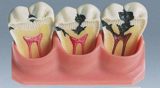 Как удалить пульпит зуба?