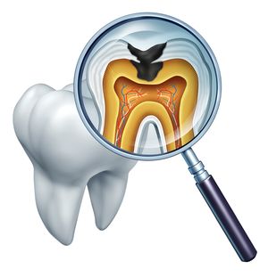 Как лечат кариес передних и жевательных зубов?