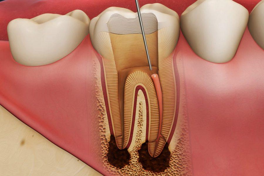 Зубная боль - виды, причины, лечение, чем снять, что делать, если болит зуб